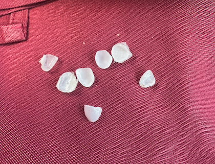 Veneers in napkin.png