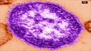 MEASLES3.jpg