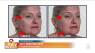 Getting Rid of Those Under-Eye Bags with Plexaderm