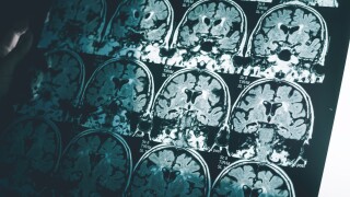 Alzheimer's,Disease,On,Mri