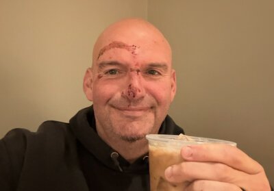 Sen. John Fetterman shows off his injuries following a fall. 