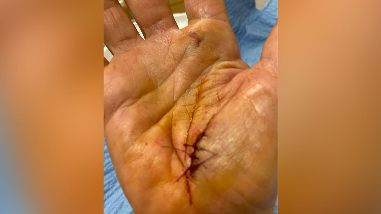 Suzan Marciano, hand wound from attack by alligator in west Boca Raton
