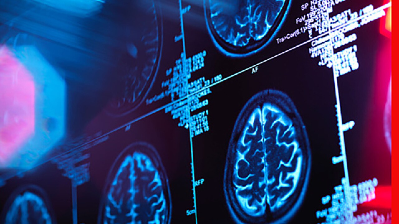 Daytime sleepiness linked with Alzheimer's disease, Johns Hopkins Study finds