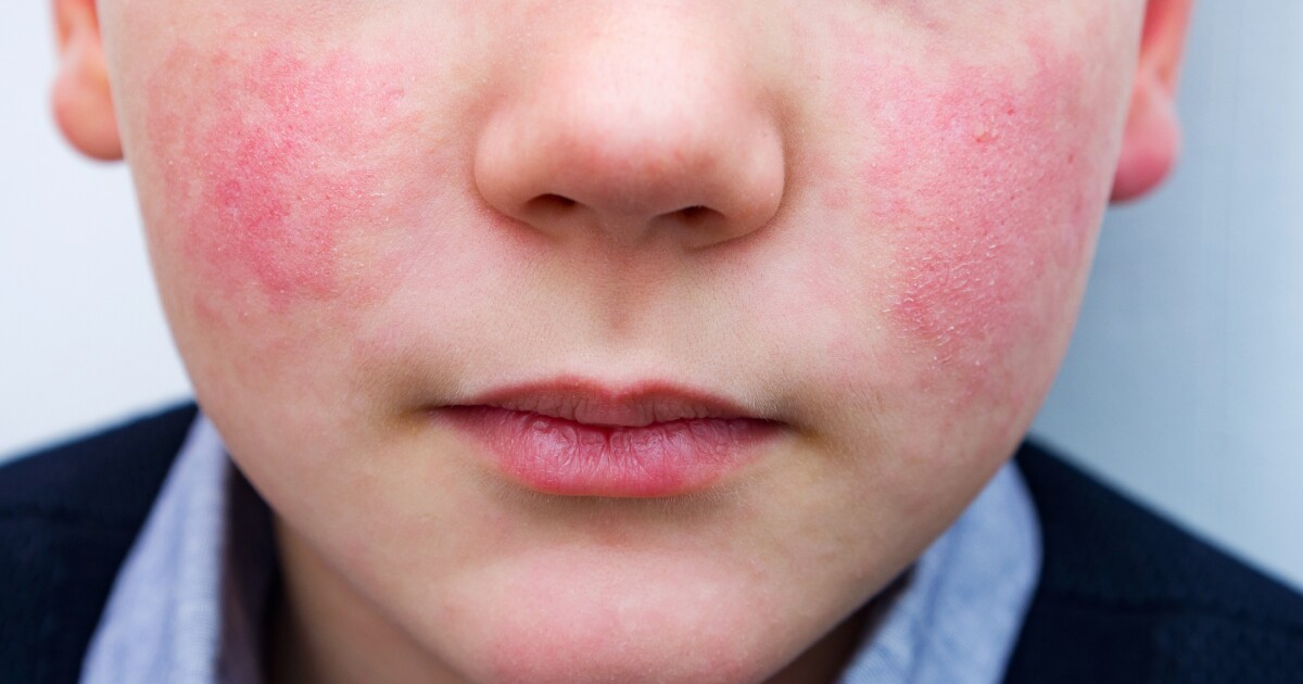 Parvo Alert: Spike in Cases Hits Hamilton County – What You Need to Know