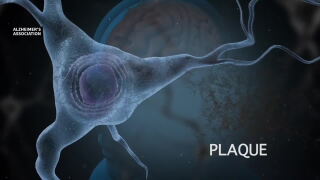 Finding new ways to fight Alzheimer's