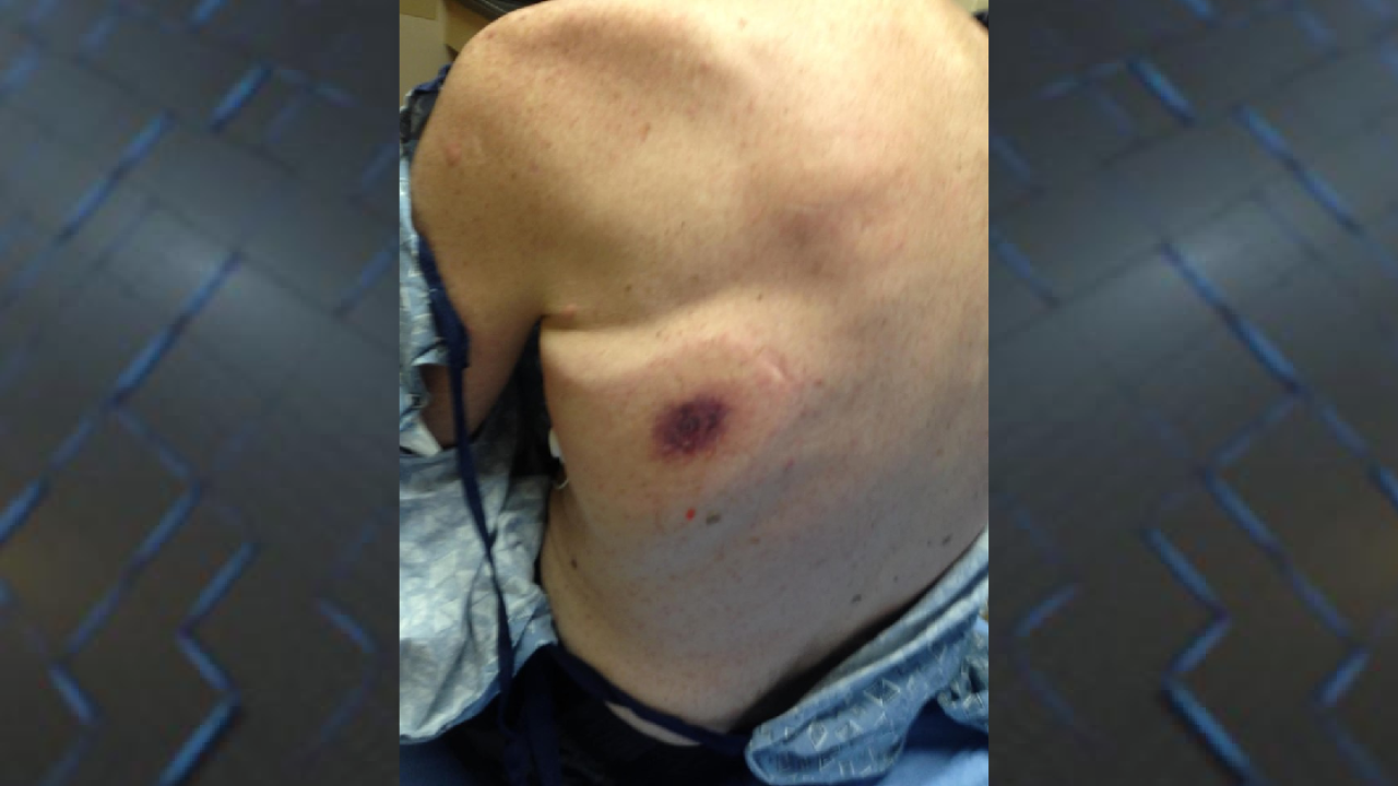 florida woman says father died after contracting flesh flesh eating bacteria pictures