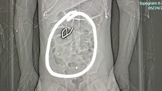 Xray