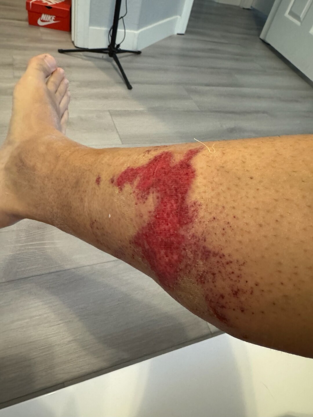 CCFD firefighter burns