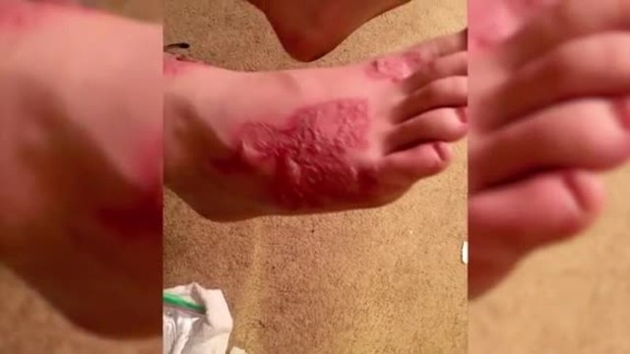 Memphis Mom Says Son Infected By Hookworms While Visiting