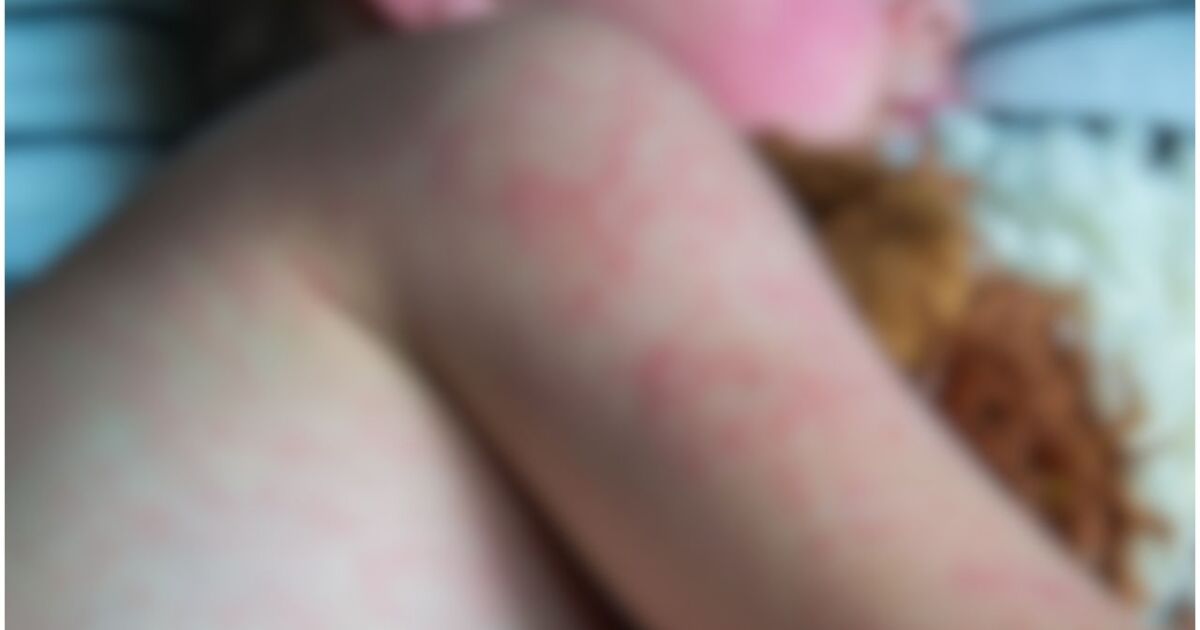 Potential exposure sites released after Virginia child tests positive for 'highly contagious' measles