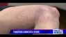 Treating varicose veins