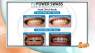 Get a brighter, whiter smile with Power Swabs