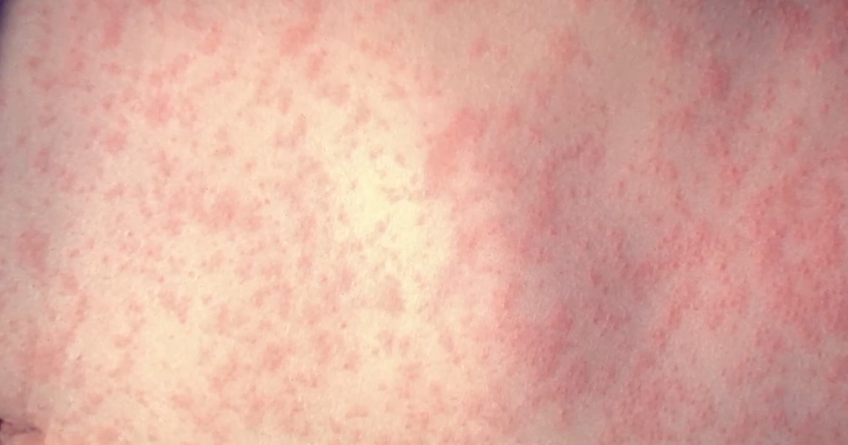 Kern County confirms first measles cases in residents since 2004 as health officials urge vaccination checks