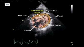 What is cardiac tamponade? Experts explain the rare condition after Nampa Mayor Rick Hogaboam's death