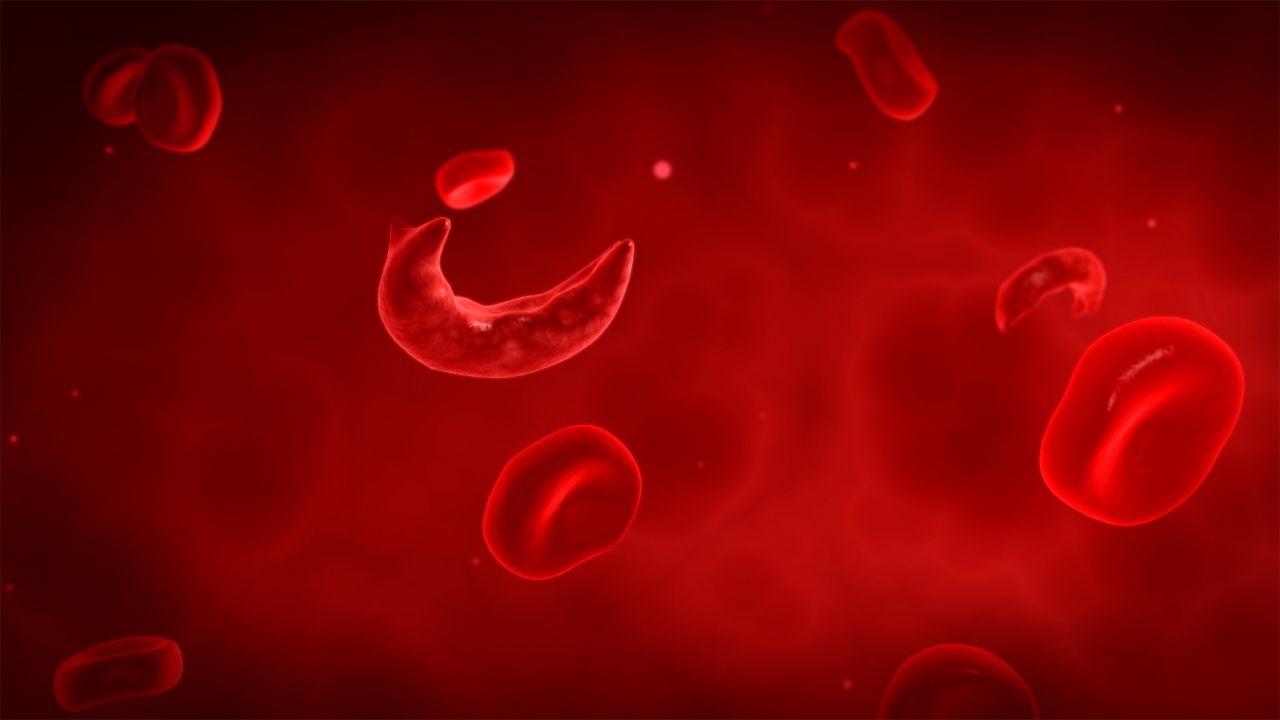 Sickle Cell Disease 2.png