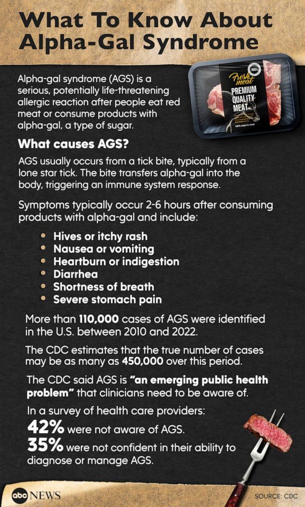 What To Know About Alpha-Gal Syndrome
ABC News Photo Illustration, Getty - LauriPatterson