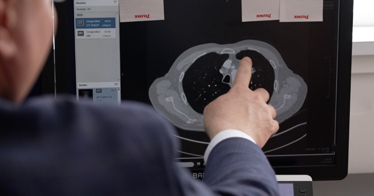 New therapies change lung cancer outlook, Colorado doctor says New therapies change lung cancer outlook, Colorado doctor says