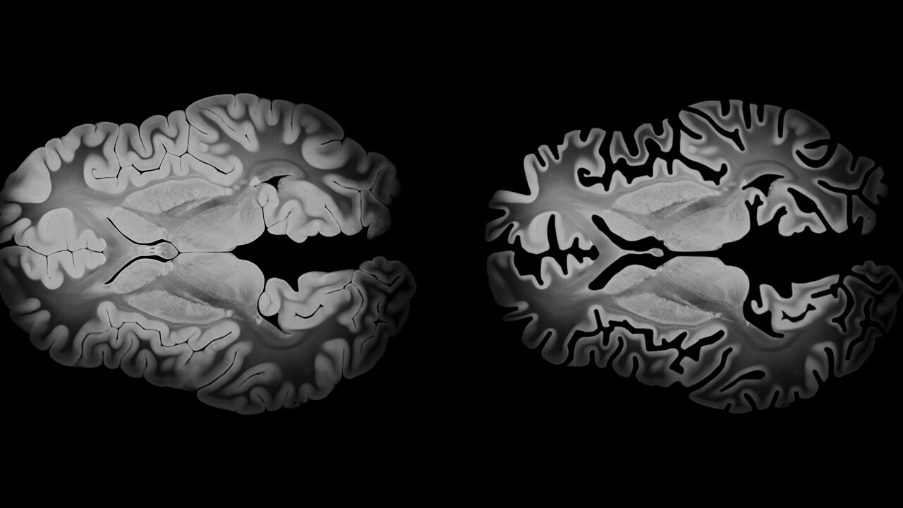 Alzheimer,Brain,Comparison,In,Axial,View,Showing,Differences,Between,A