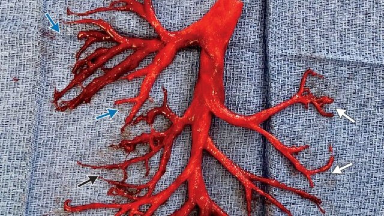 Download Man Coughs Up Astonishing Blood Clot Shaped Like A Bronchial Tree For Free Get Wallpaper Man Coughs Up Astonishing Blood Clot Shaped Like A Bronchial Tree Desktop Wallpaper Free