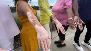 Vitiligo.png