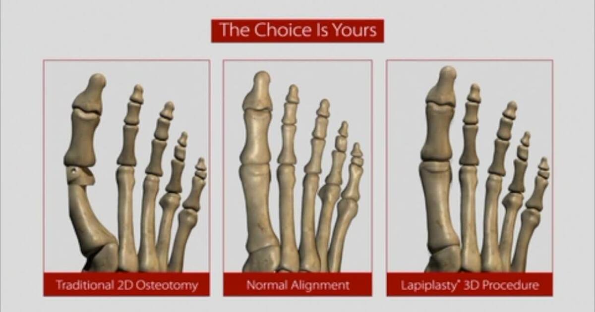 Remove Bunions With Lapiplasty 3d Bunion Correction
