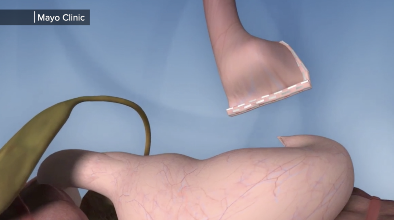 Photo 2 gastric bypass.png