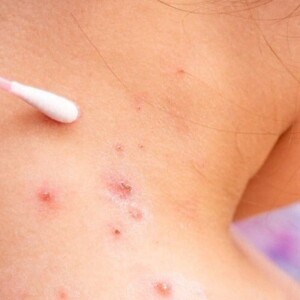 measles3.jpg