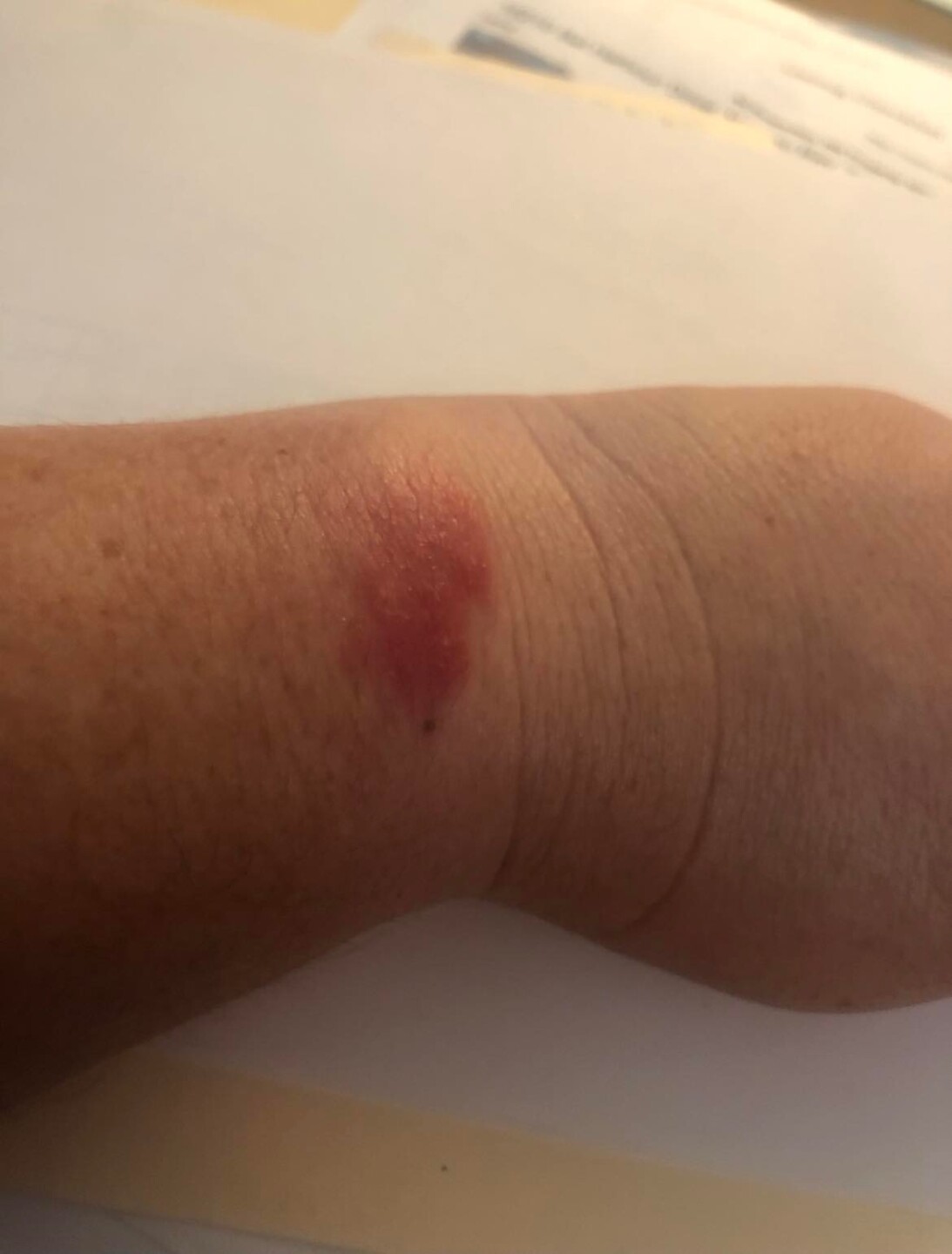 Fitbit watch burn Clearance