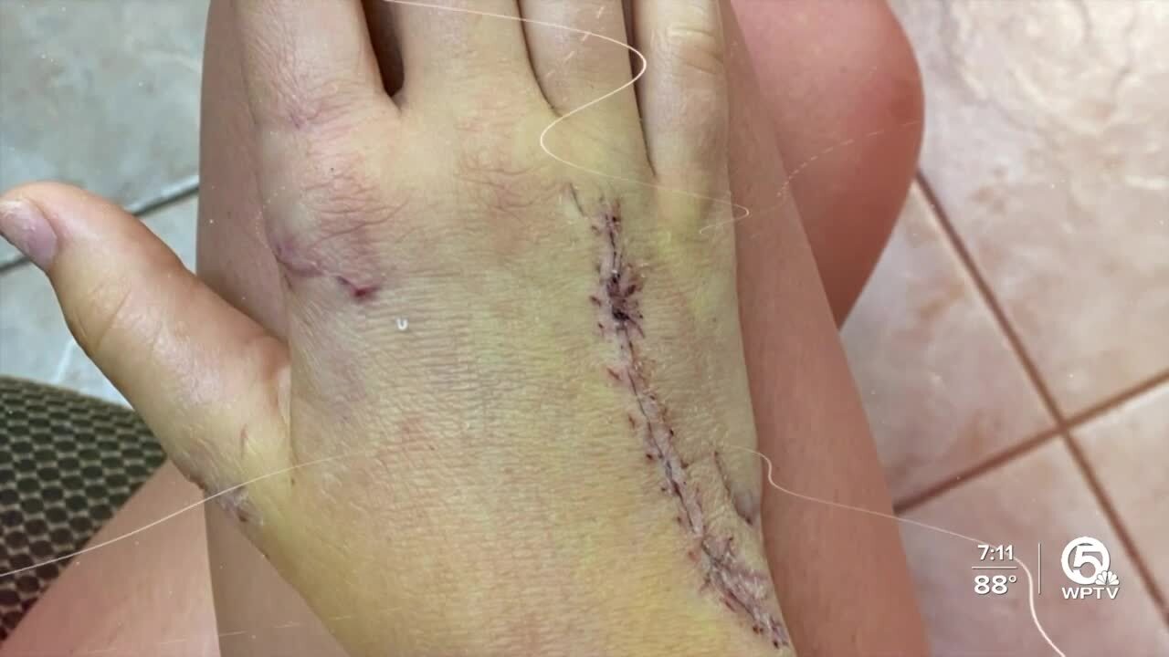 Sophia Scroggie's hand after shark attack