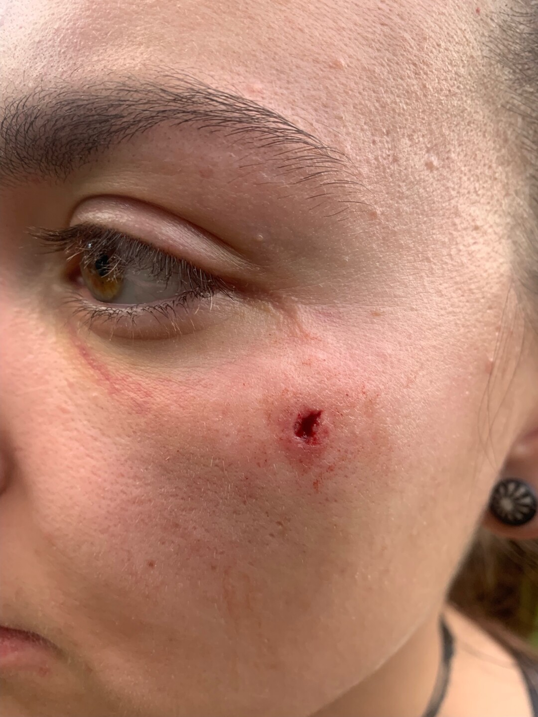 Greta Cooper-Coe's wound from BB gun