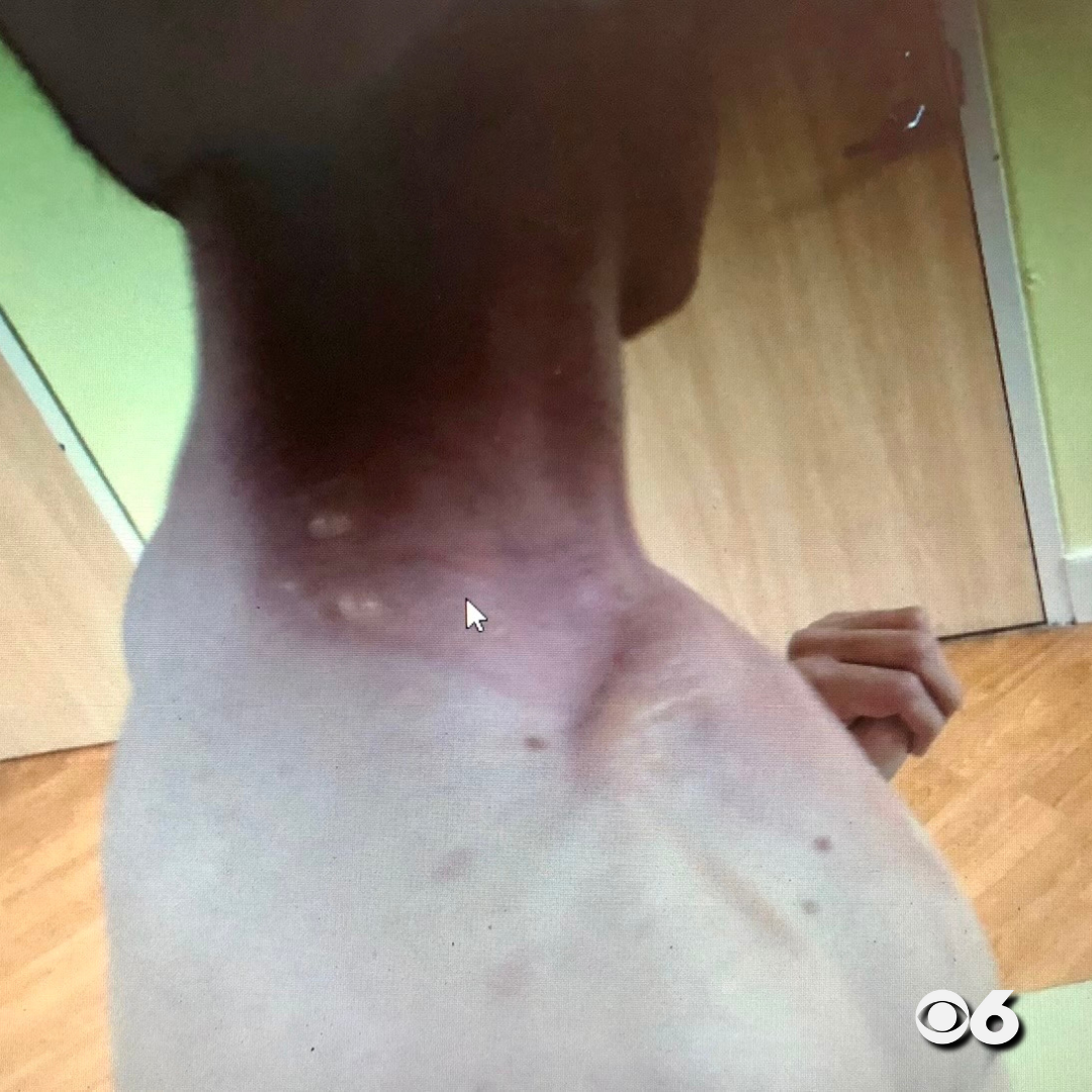 Jackson Haddon burn pic 1.png