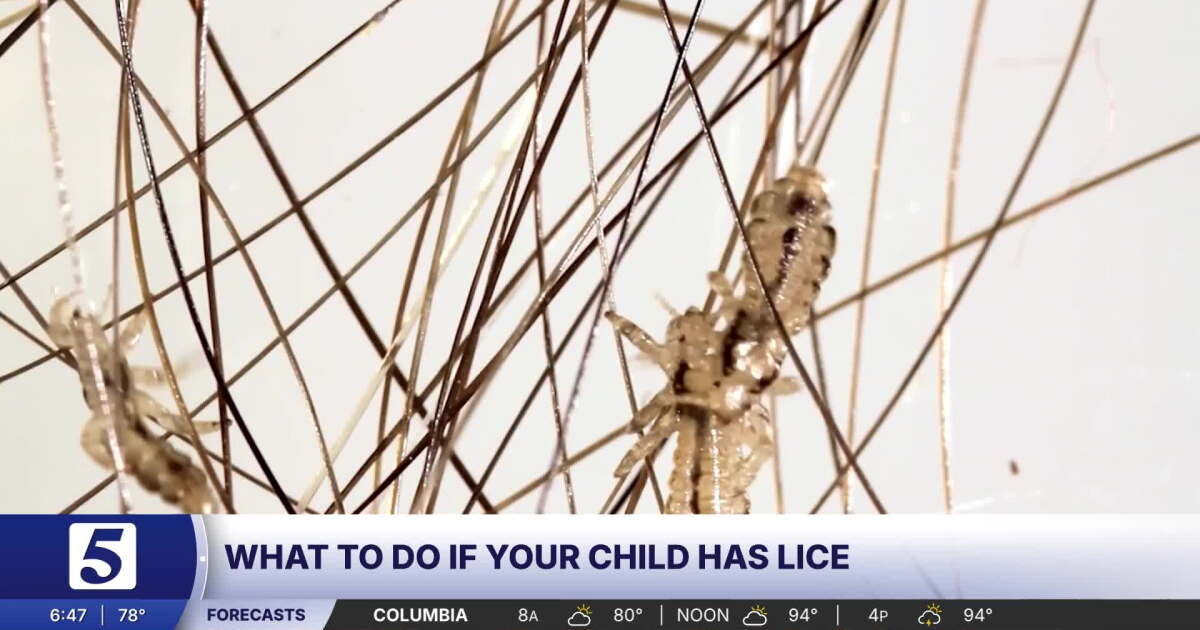 How to deal with head lice during back-to-school season