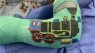 Orthopedic surgeon uses art to personalize casts for kids