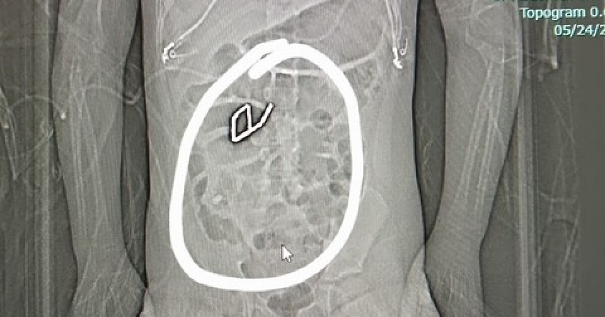 A mother warns about the danger of magnetic toy blocks after her daughter is hospitalized in Colorado