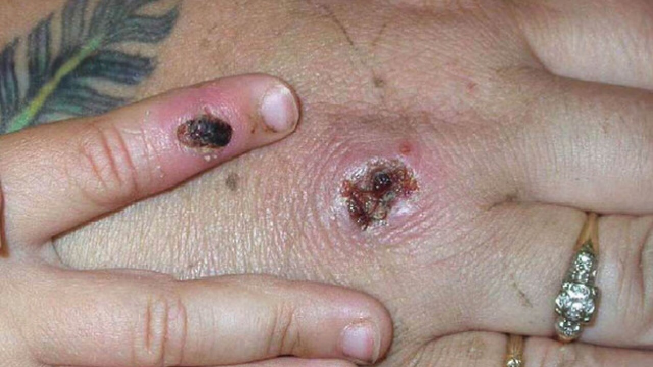 Monkeypox: First cases of rare infection diagnosed in UK