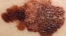 New melanoma drug increases survival rate