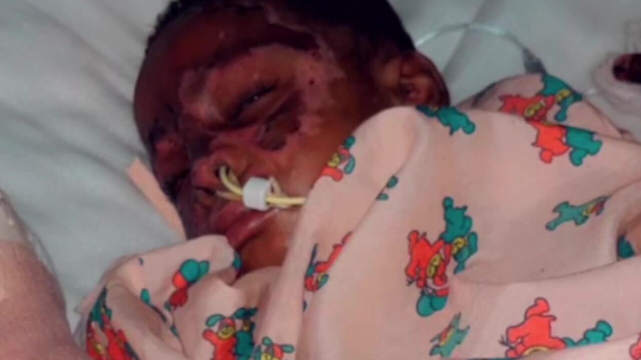 Baby Johnny recovers from burns sustained in a Delray Beach house fire on March 5, 2022.jpg