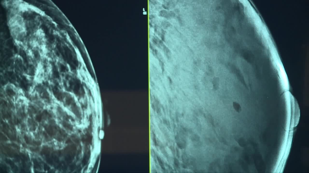 Breast Cancer Generic