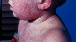 measles1.png