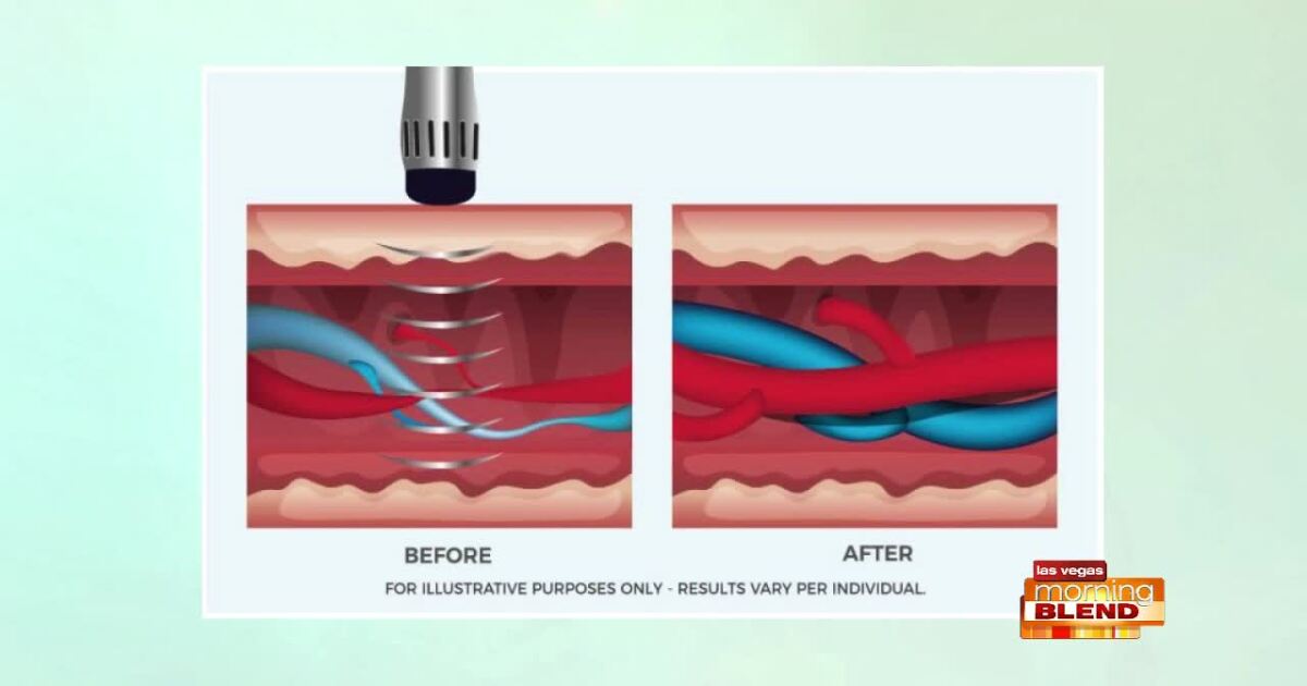 New Treatment for E.D.