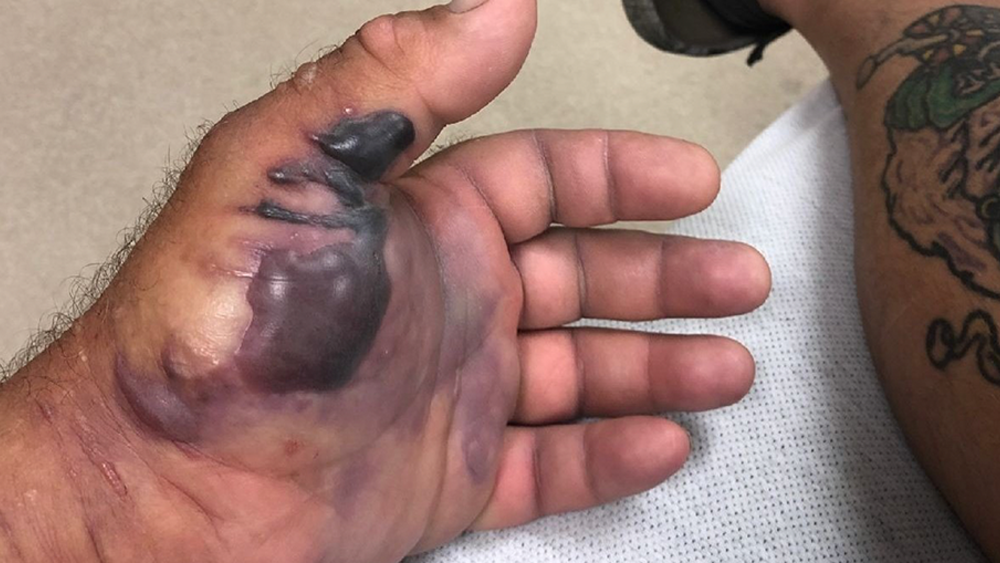 flesh-eating-bacteria-gulf-coast-palm-harbor-mike-walton.png