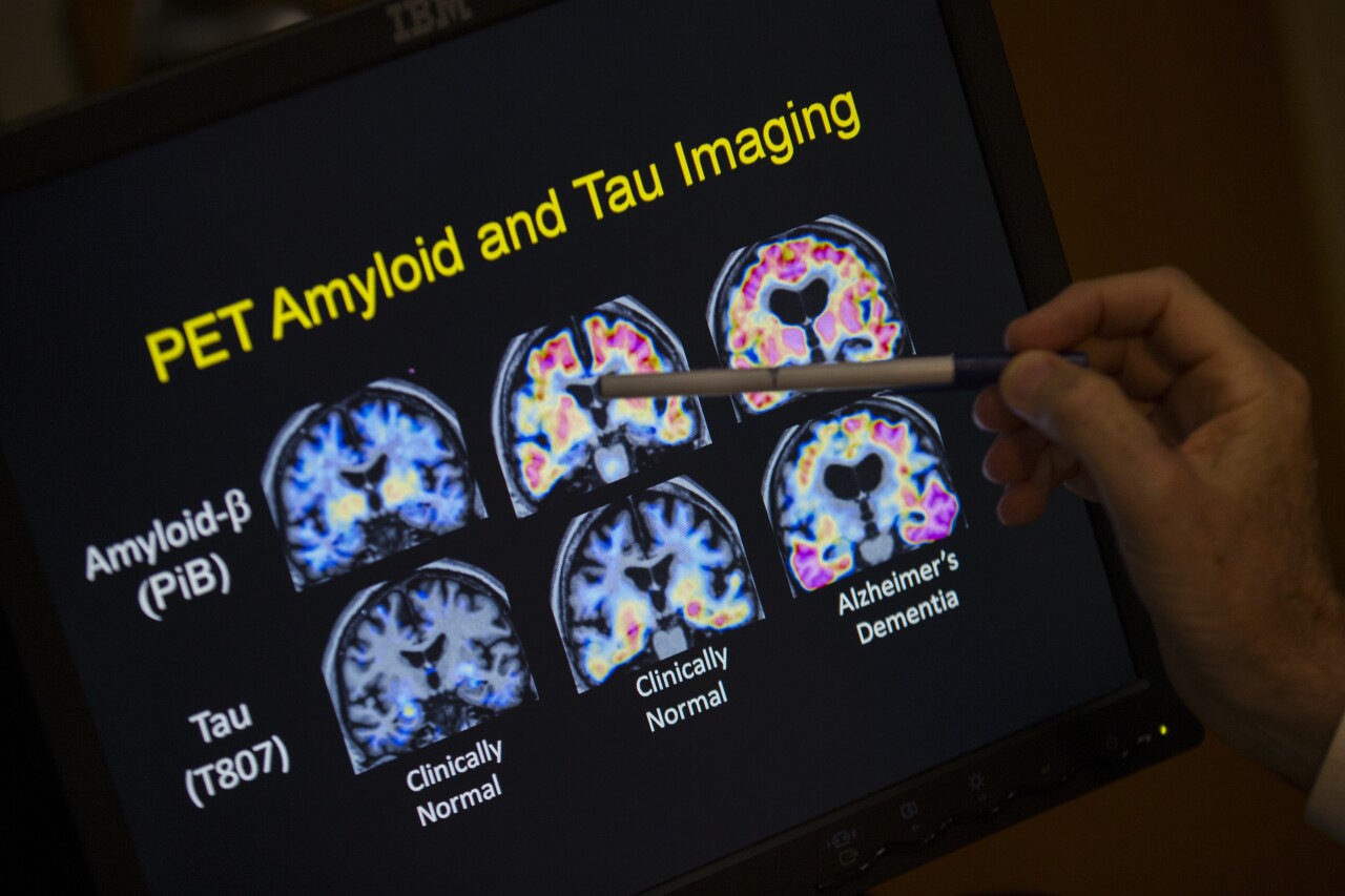 Be Well-Alzheimer’s-Blood Tests