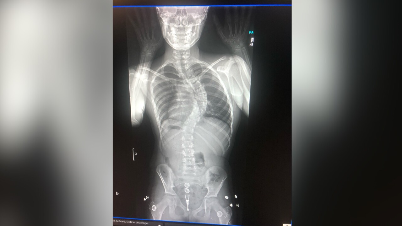 SCOLIOSIS