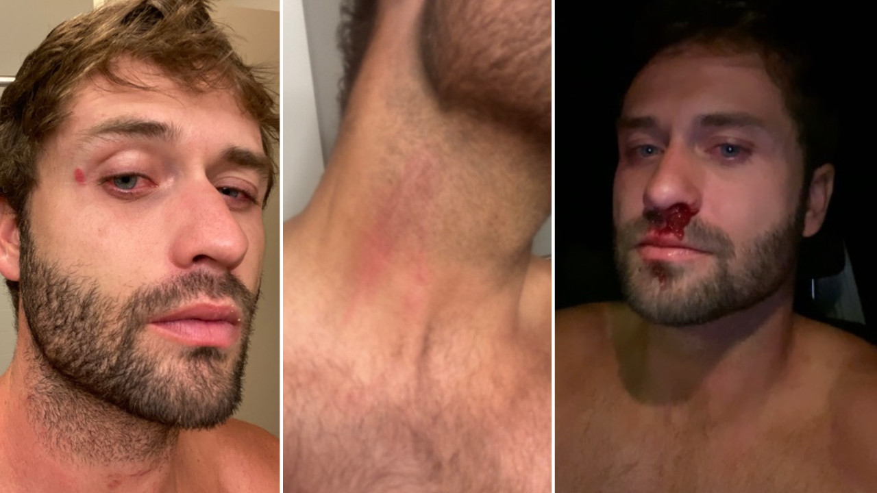 Mortensen Injuries.png