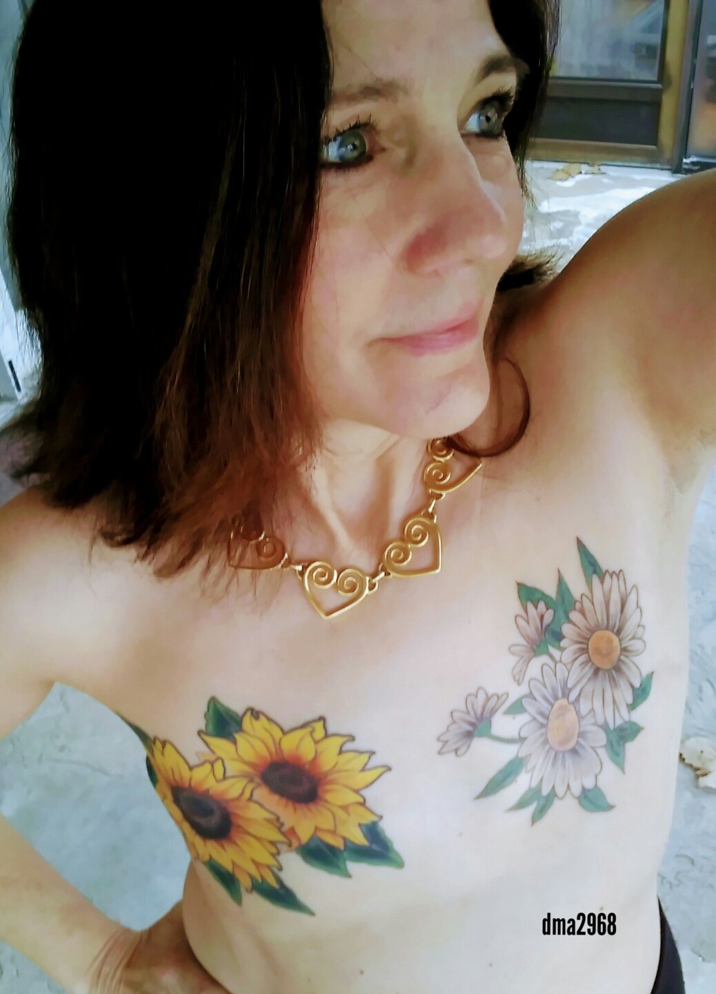 Diane Smith - promoting awareness for Aesthetic Flat Closure