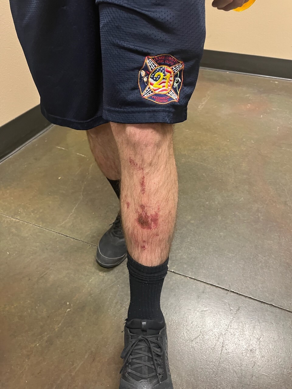 CCFD firefighter burns