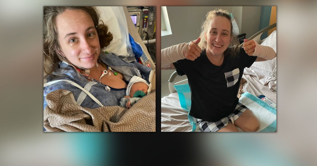 VB woman loses leg while battling sepsis for 10 weeks after giving birth - Vimarsana News