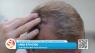New technology for hair restoration at Scottsdale Institute for Cosmetic Dermatology