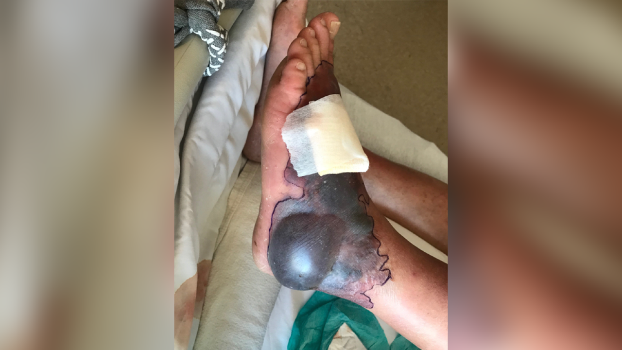 Vibrio Vulnificus Florida Map Everything you need to know about the flesh eating bacteria Vibrio Vulnificus Florida Map Everything you need to know about the flesh eating bacteria