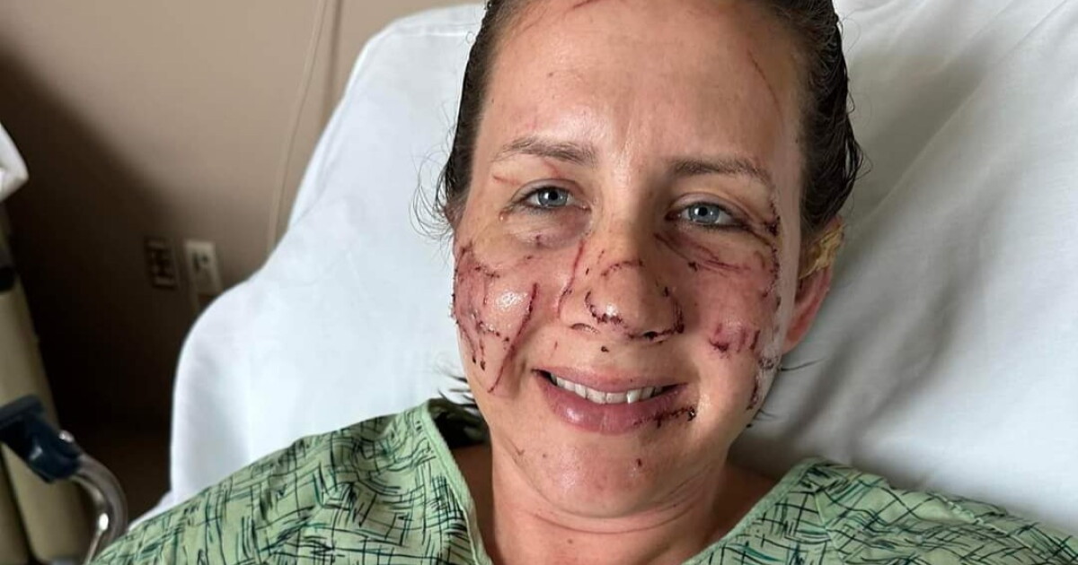 Fundraising efforts underway for otter attack victims - Vimarsana News